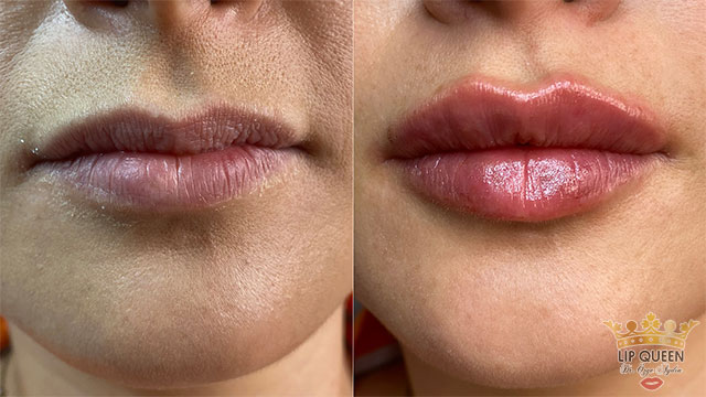 lip queen lip filler ankara doctor Ozge AYDIN