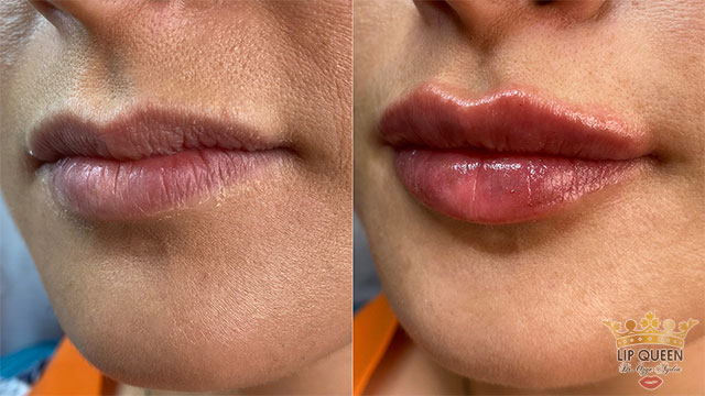 lip queen lip filler ankara doctor Ozge AYDIN