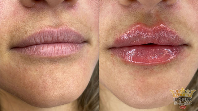 lip queen lip filler ankara doctor Ozge AYDIN