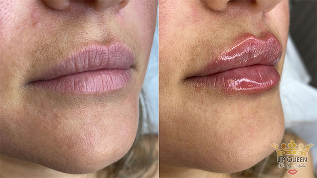lip queen lip filler ankara doctor Ozge AYDIN