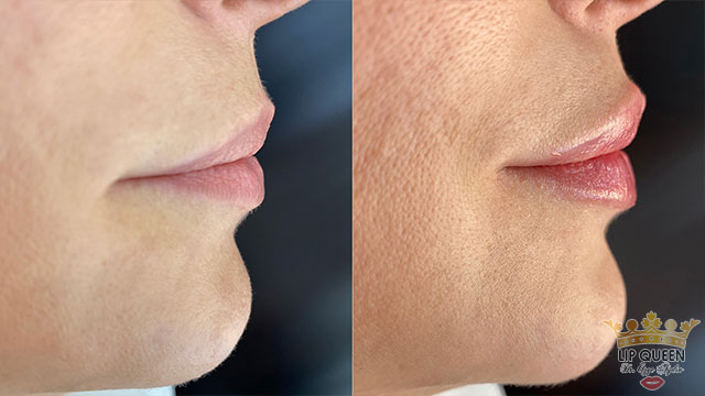 lip queen lip filler ankara doctor Ozge AYDIN