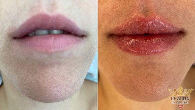 lip queen lip filler ankara doctor Ozge AYDIN