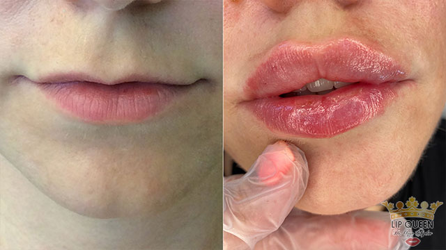 lip queen lip filler ankara doctor Ozge AYDIN