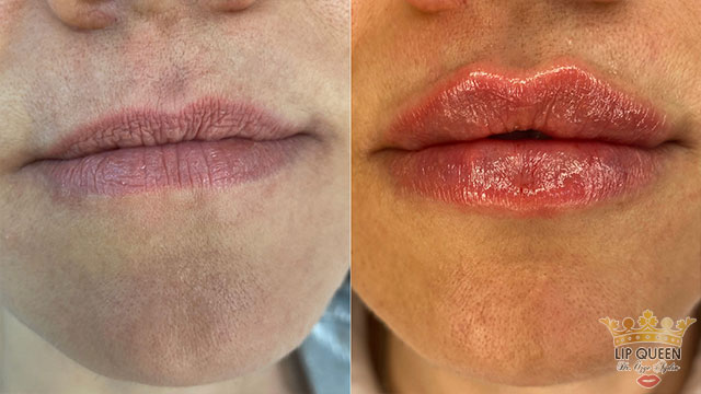 lip queen lip filler ankara doctor Ozge AYDIN
