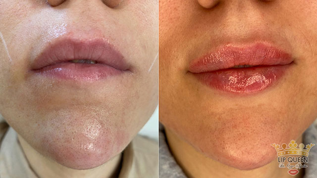lip queen lip filler ankara doctor Ozge AYDIN