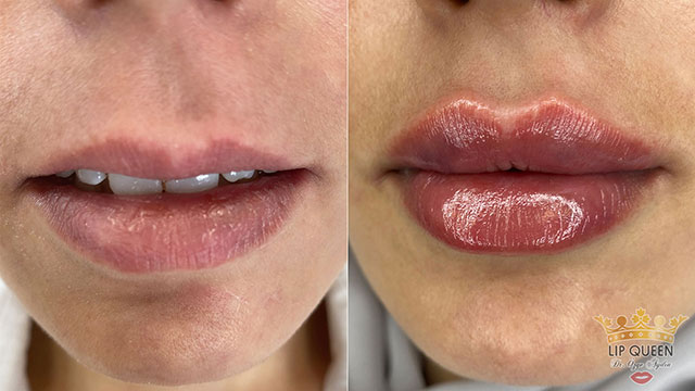lip queen lip filler ankara doctor Ozge AYDIN