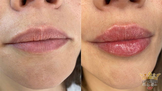 lip queen lip filler ankara doctor Ozge AYDIN