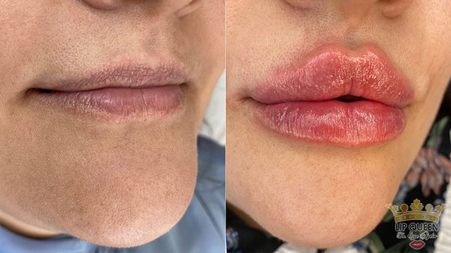 lip queen lip filler ankara doctor Ozge AYDIN