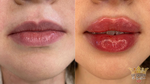 lip queen lip filler ankara doctor Ozge AYDIN