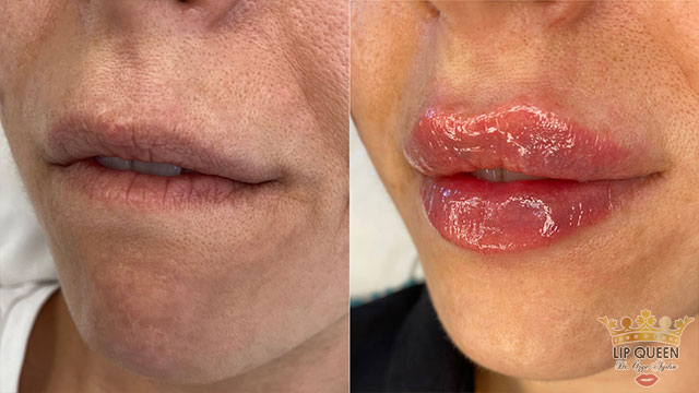 lip queen lip filler ankara doctor Ozge AYDIN