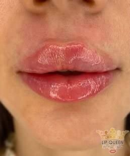 lip queen lip filler ankara doctor Ozge AYDIN
