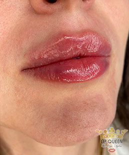 lip queen lip filler ankara doctor Ozge AYDIN