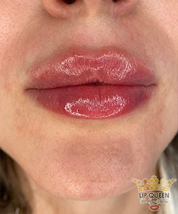 lip queen lip filler ankara doctor Ozge AYDIN