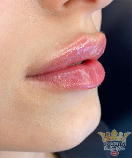lip queen lip filler ankara doctor Ozge AYDIN