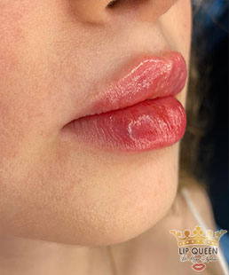 lip queen lip filler ankara doctor Ozge AYDIN
