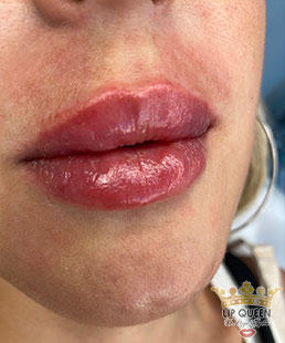 lip queen lip filler ankara doctor Ozge AYDIN