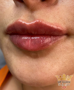 lip queen lip filler ankara doctor Ozge AYDIN