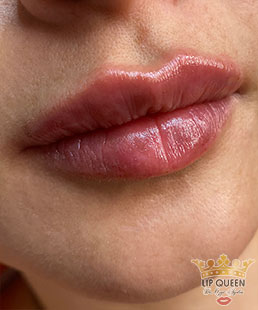 lip queen lip filler ankara doctor Ozge AYDIN